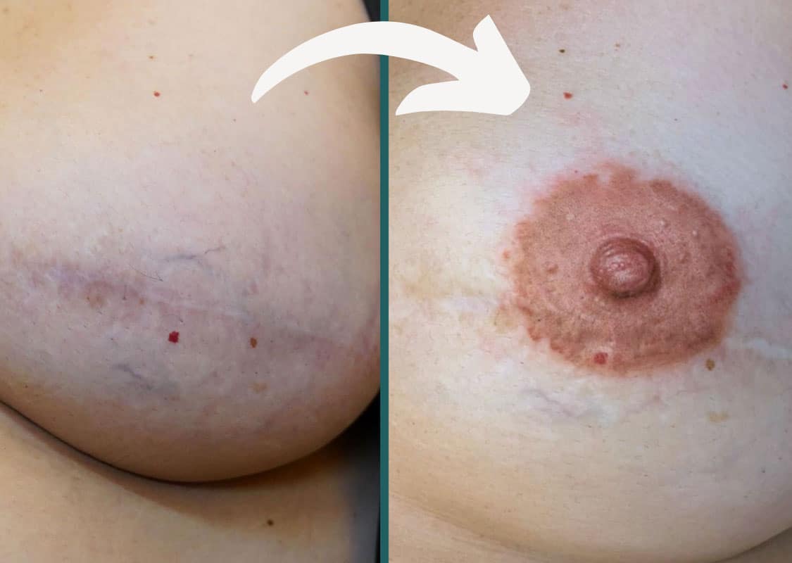 Vorher-Nachher-Ergebnis: 3D-Tattoo zur Brustwarzenrekonstruktion