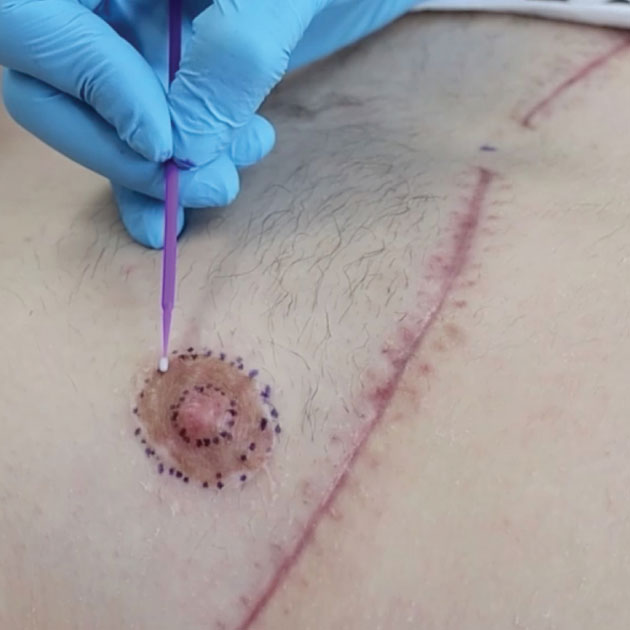 Vorbereitung Brustwarzen-Tattoo als Teilrekonstruktion